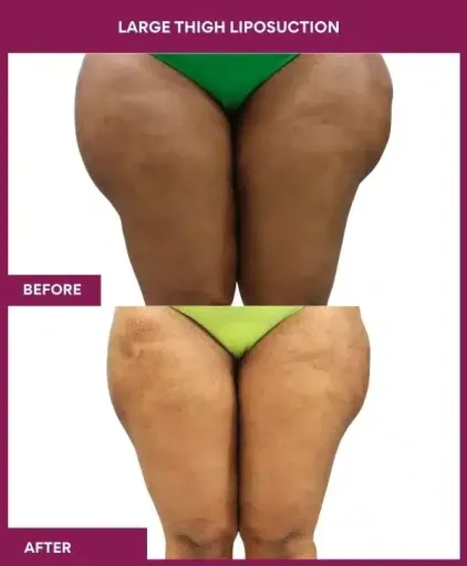 22 Large Thigh Liposuction