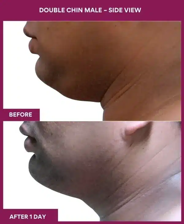 24 Double Chin Male – Side View