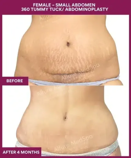 3 FEMALE – SMALL ABDOMEN 360 TUMMY TUCK_ ABDOMINOPLASTY_9