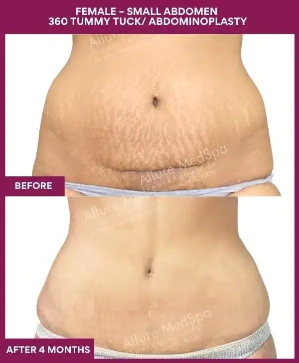Tummy Tuck Surgery Cost 9 3 FEMALE – SMALL ABDOMEN 360 TUMMY TUCK_ ABDOMINOPLASTY_9