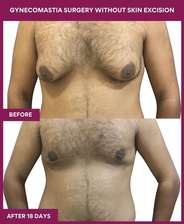3 Gynecomastia Surgery without Skin excision_50_ (1)