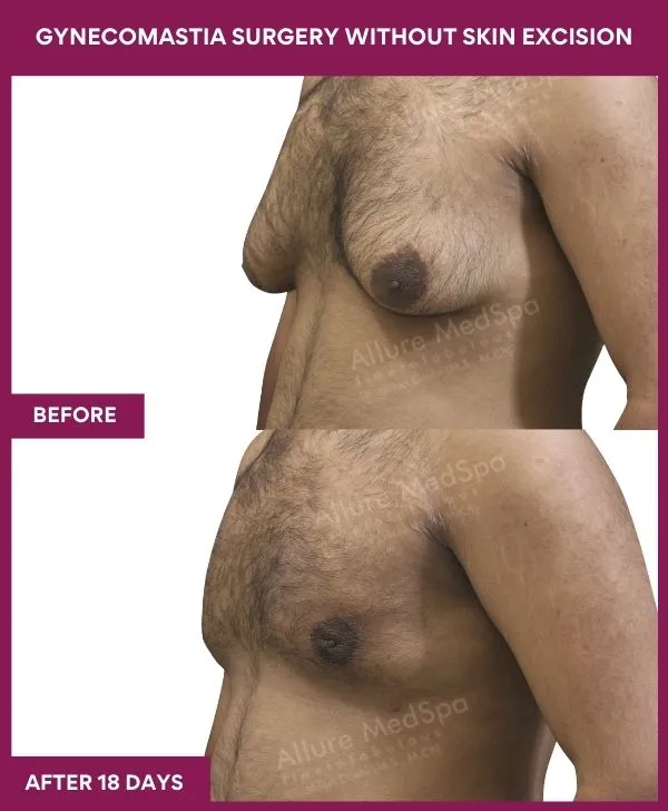 3 Gynecomastia Surgery without Skin excision_50_ (3)