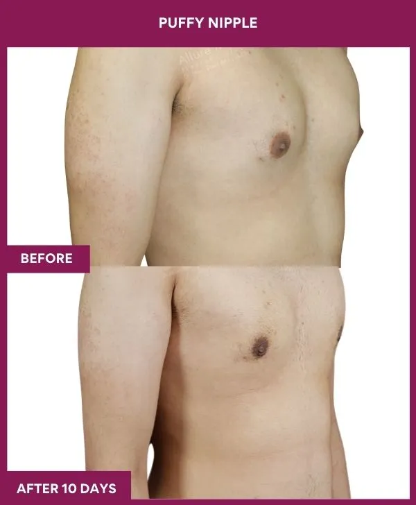 3 PUFFY NIPPLE (6)_68_