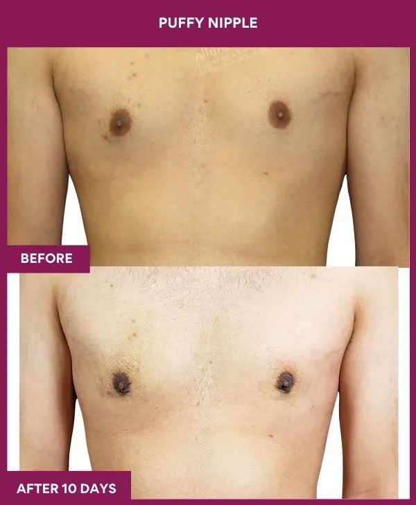 3 PUFFY NIPPLE (7)_68_