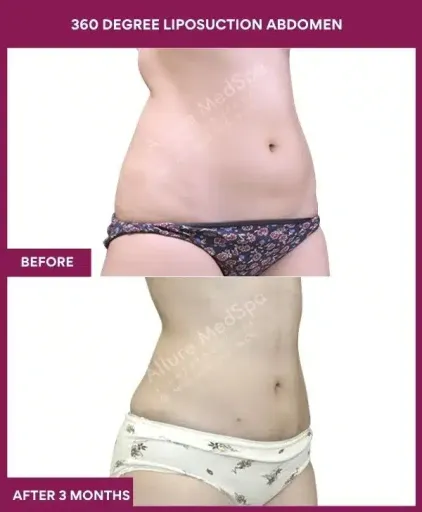 4- 360 DEGREE LIPOSUCTION ABDOMEN