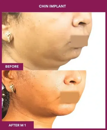 4 Chin Implant in Mumbai, India