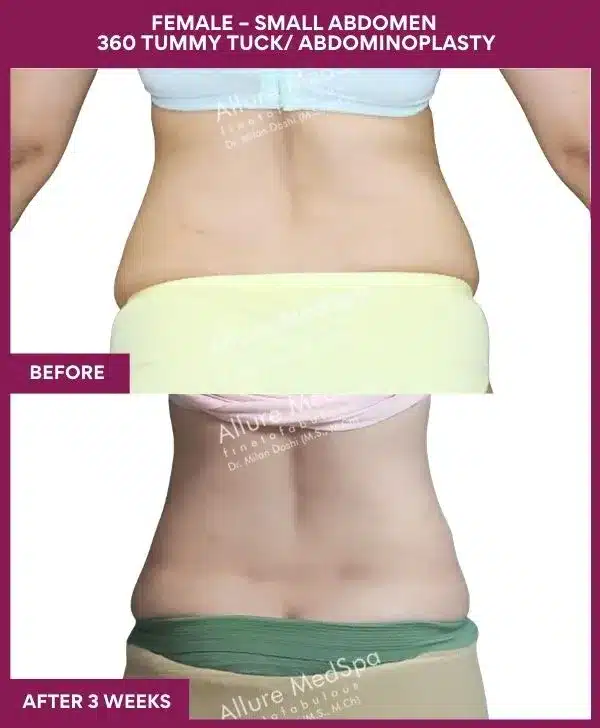 Tummy Tuck Surgery Cost 12 4 FEMALE – SMALL ABDOMEN 360 TUMMY TUCK_ ABDOMINOPLASTY (2)_10