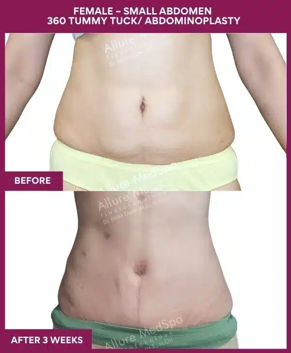 Tummy Tuck Surgery Cost 11 4 FEMALE – SMALL ABDOMEN 360 TUMMY TUCK_ ABDOMINOPLASTY_12