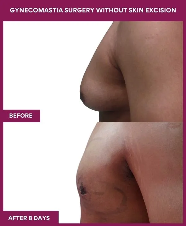 4Gynecomastia Surgery without Skin excision (3)_51_
