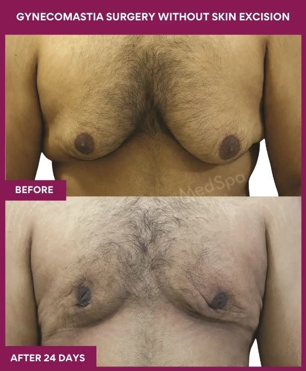 5 Gynecomastia Surgery without Skin excision_56_ (1)