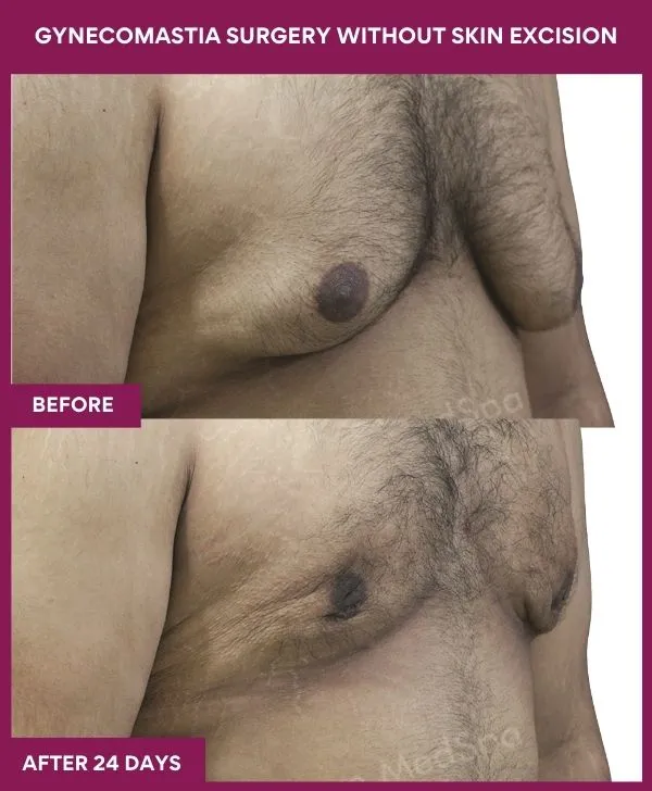5 Gynecomastia Surgery without Skin excision_56_ (3)