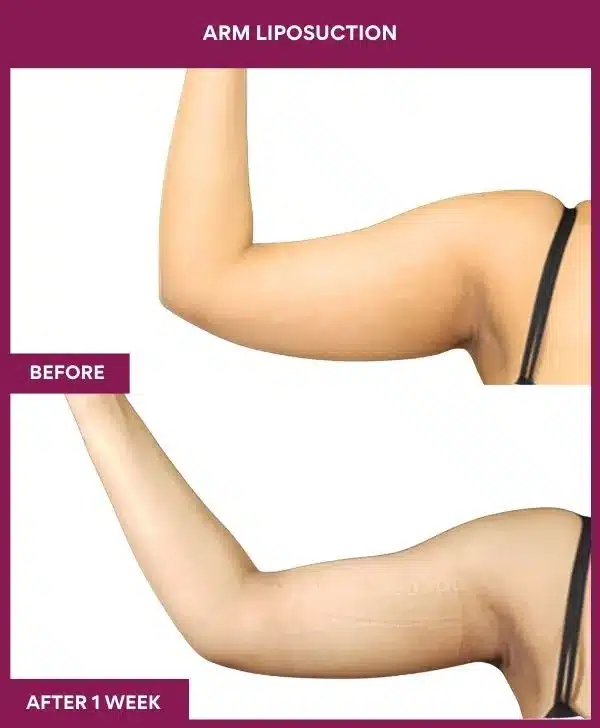 6 Arm Liposuction (6)_24_