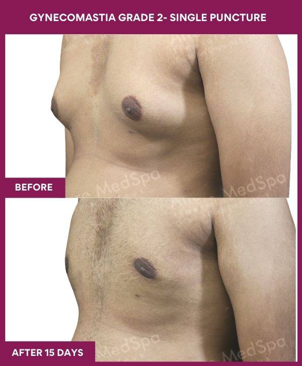 6-GYNAECOMASTIA GRADE 2-SINGLE PUNCTURE (3)