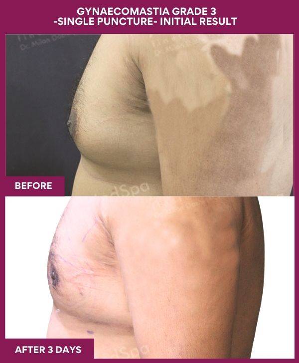 6-GYNAECOMASTIA GRADE 3 -SINGLE PUNCTURE- INITIAL RESULT (3)
