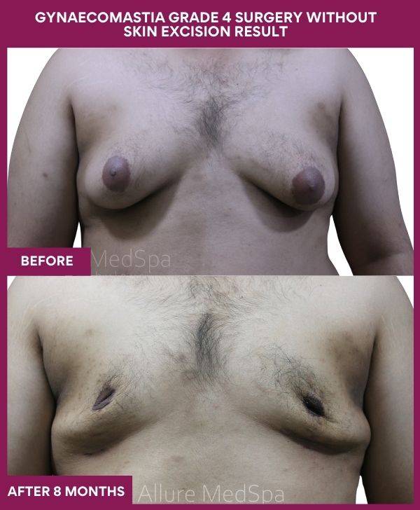 6- GYNAECOMASTIA GRADE 4 SURGERY WITHOUT SKIN EXCISION RESULT (2)
