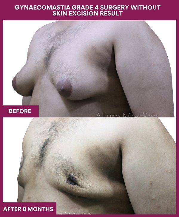 6 - GYNAECOMASTIA GRADE 4 SURGERY WITHOUT SKIN EXCISION RESULT (2)