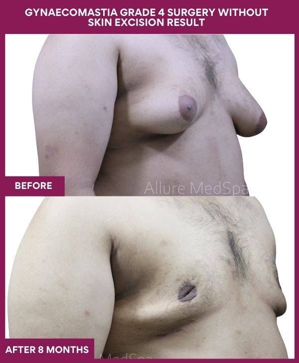 6 - GYNAECOMASTIA GRADE 4 SURGERY WITHOUT SKIN EXCISION RESULT (3)