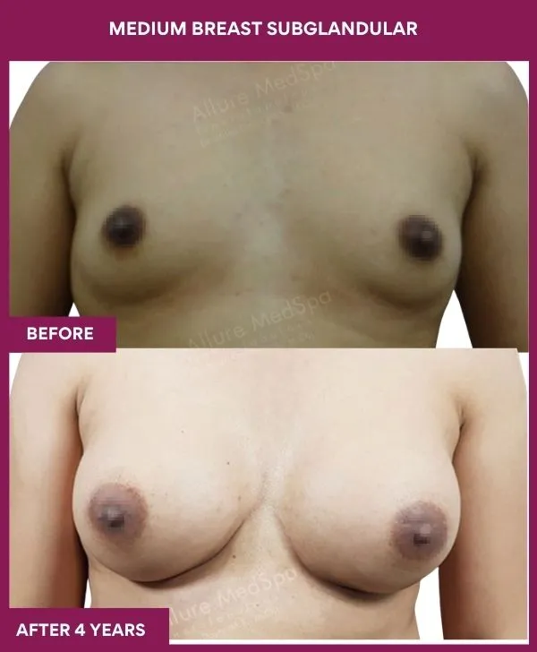 6 Medium breast subglandular (4)_15_