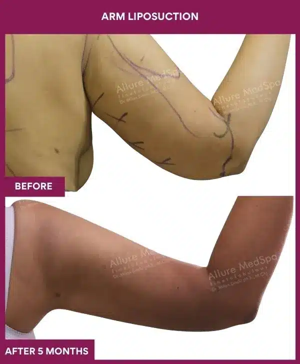 7 Arm Liposuction_31 (1)
