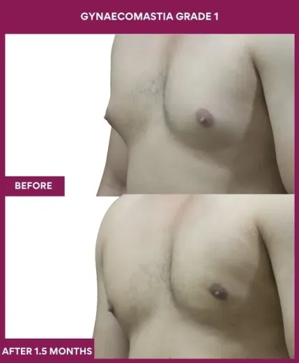 GYNAECOMASTIA GRADE 1 Surgery in Mumbai, India
