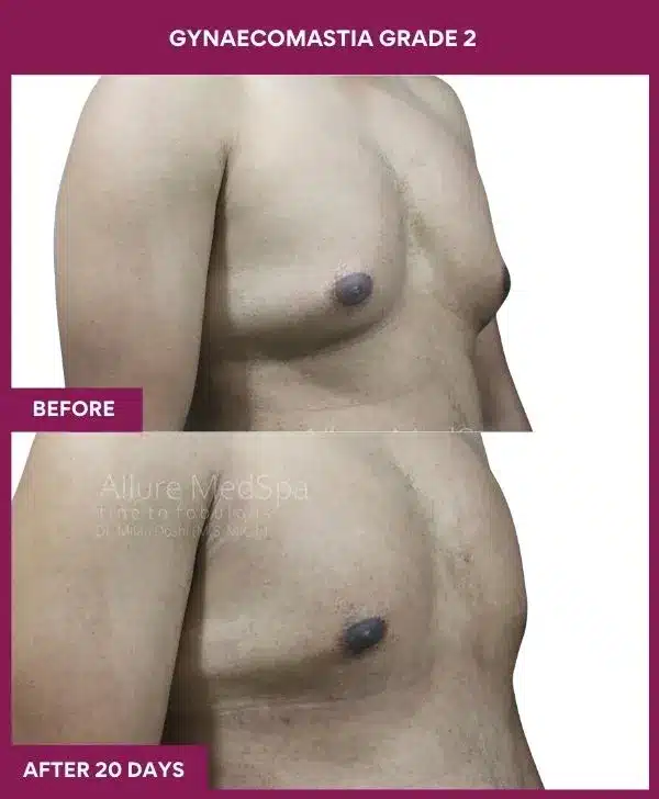 7-GYNAECOMASTIA GRADE 2 (2)