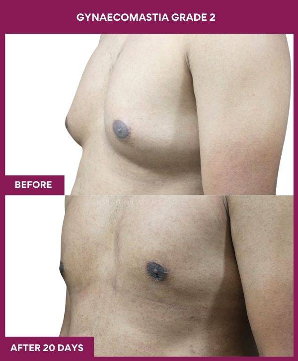 7-GYNAECOMASTIA GRADE 2 (3)