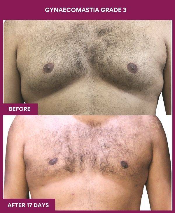 7-GYNAECOMASTIA GRADE 3 (1)