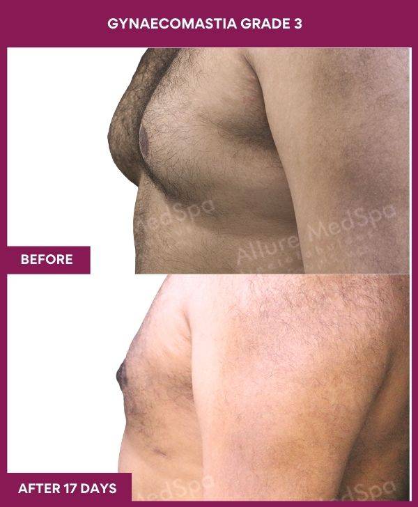 7-GYNAECOMASTIA GRADE 3 (3)