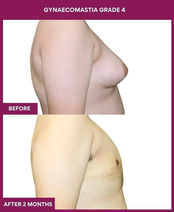 7- GYNAECOMASTIA GRADE 4 (1)