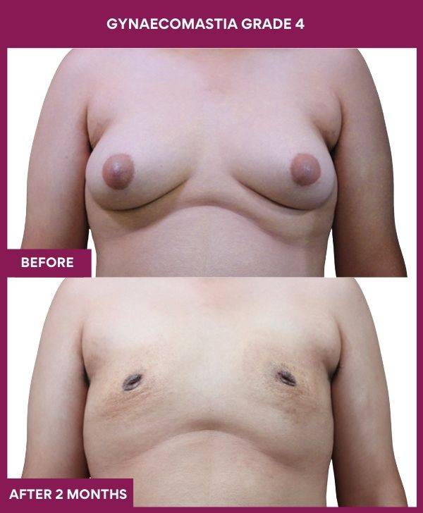 7- GYNAECOMASTIA GRADE 4 (2)