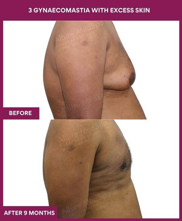 Gynaecomastia with excess skin (3)