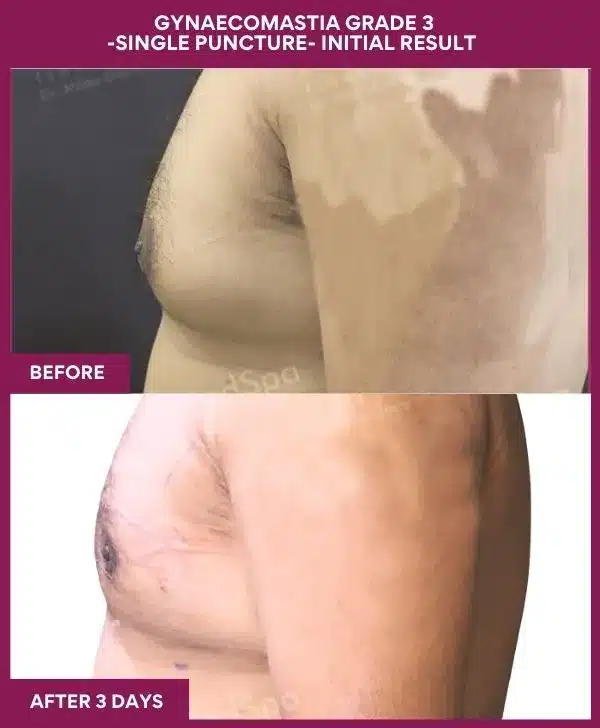 8-GYNAECOMASTIA GRADE 3 -SINGLE PUNCTURE- INITIAL RESULT (3)_