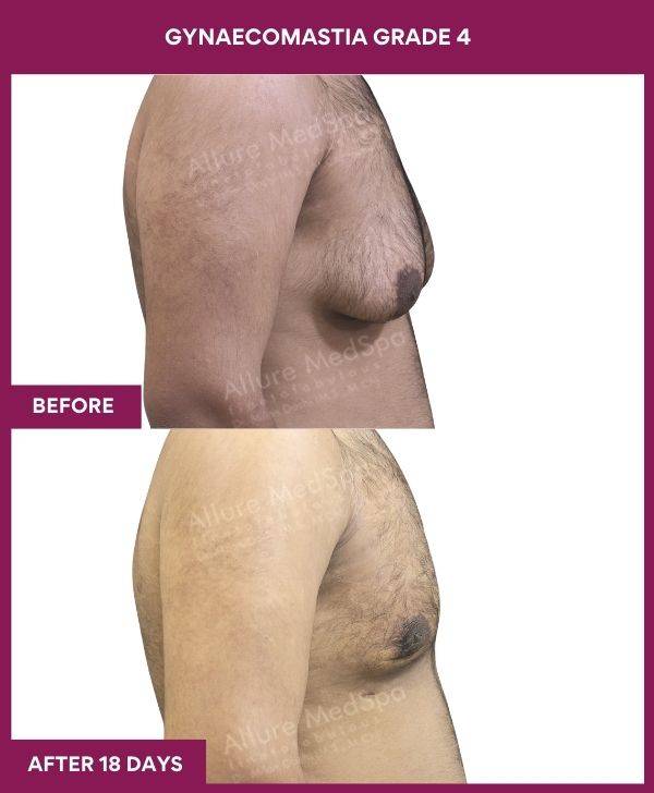 8 - GYNAECOMASTIA GRADE 4 (3)