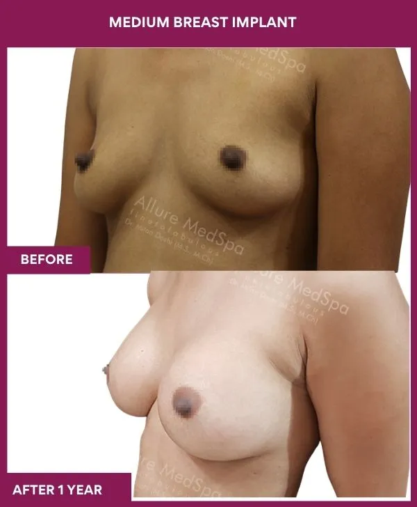 8 MEDIUM BREAST IMPLANT_23_ (3)