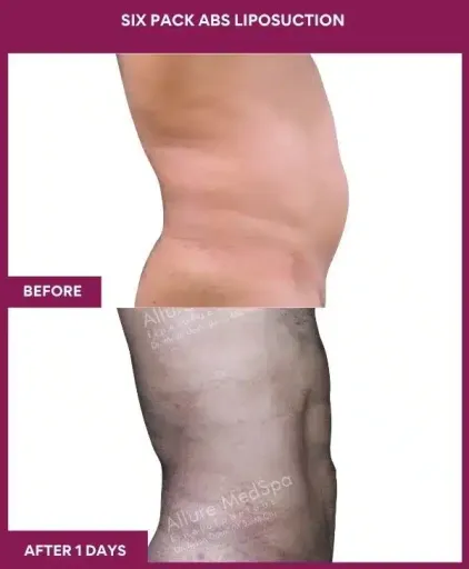 8- Six Pack Abs Liposuction-