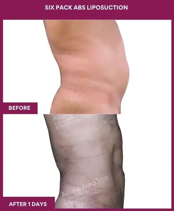 8- Six Pack Abs Liposuction-