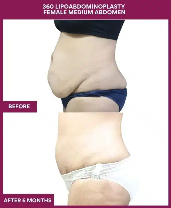 Tummy Tuck Surgery Cost 14 9 360 LIPOABDOMINOPLASTY FEMALE MEDIUM ABDOMEN (3)_26_11zon