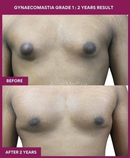 9-GYNAECOMASTIA GRADE 1 _ 2 years result (1)