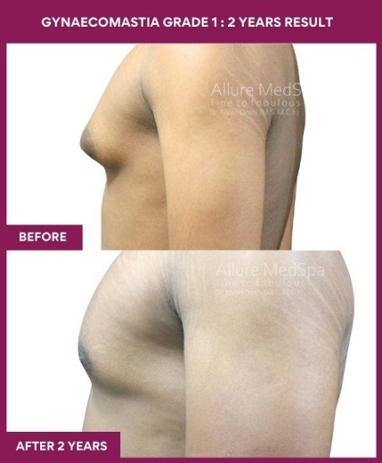 9-GYNAECOMASTIA GRADE 1 _ 2 years result (3)
