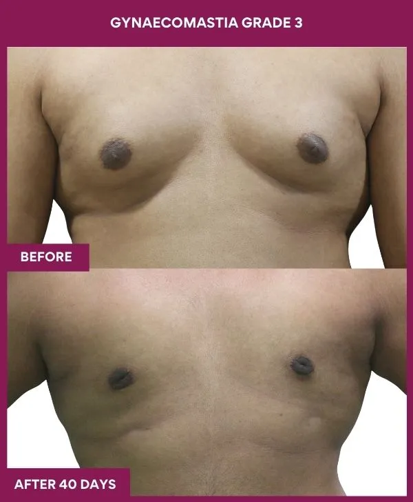 GYNAECOMASTIA GRADE 3 Surgery in Mumbai, India