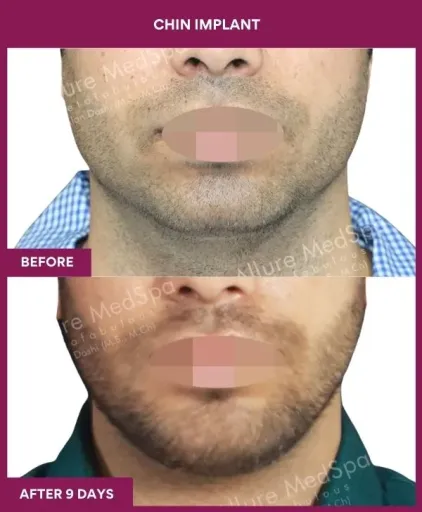 15 Chin Implant_43_ (1)