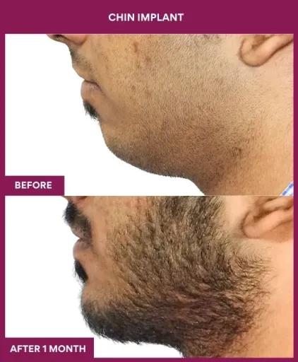 7 Chin Implant (3)_20_