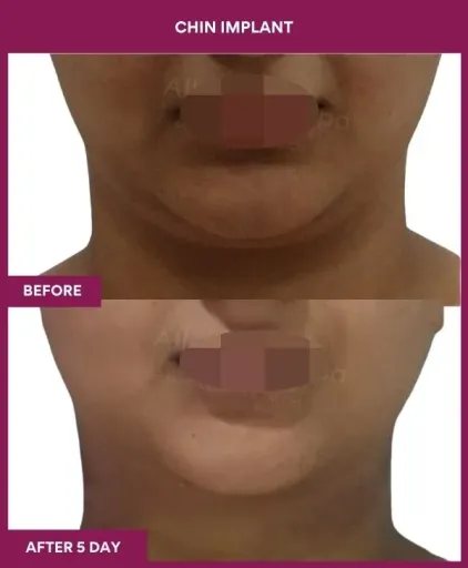 7 Chin Implant ) (4)_16_