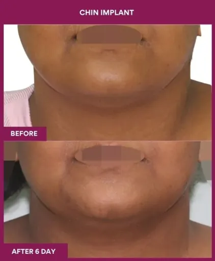 8 Chin Implant ) (4)_19_