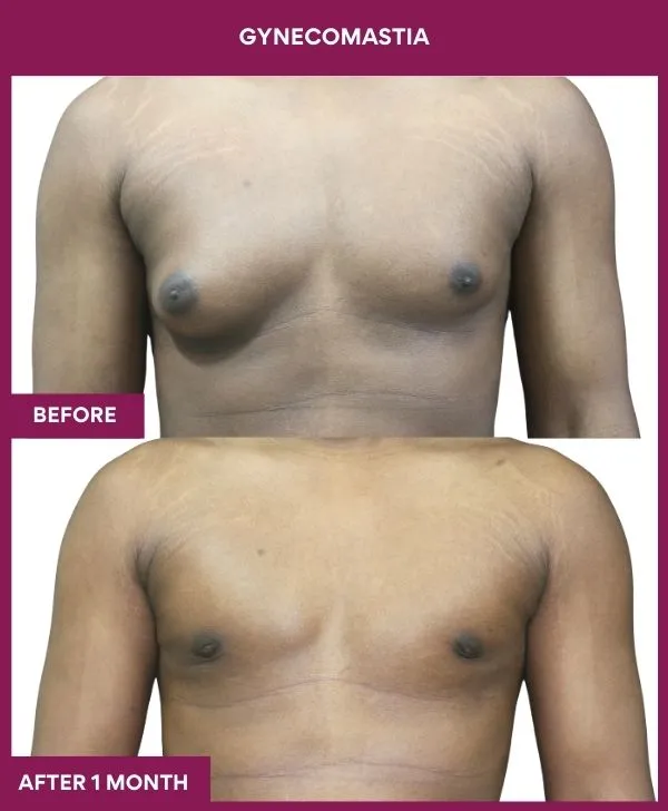 ASYMETRIC GYNECOMASTIA in Mumbai, India