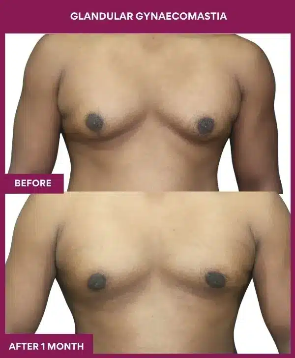 GLANDULAR GYNAECOMASTIA Surgeryin Mumbai, India