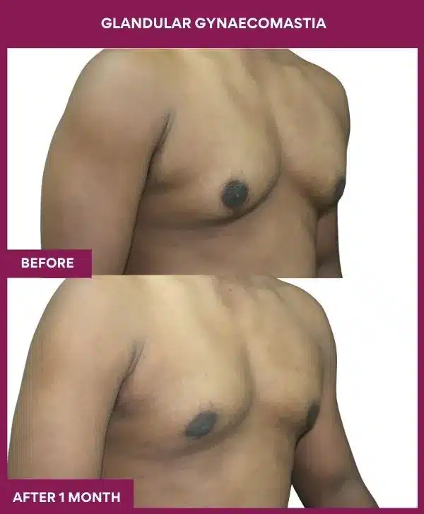 GLANDULAR GYNAECOMASTIA Surgeryin Mumbai, India