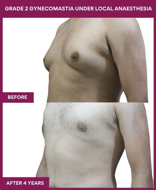 GRADE 2 GYNECOMASTIA UNDER LOCAL ANAESTHESIA in Mumbai, India