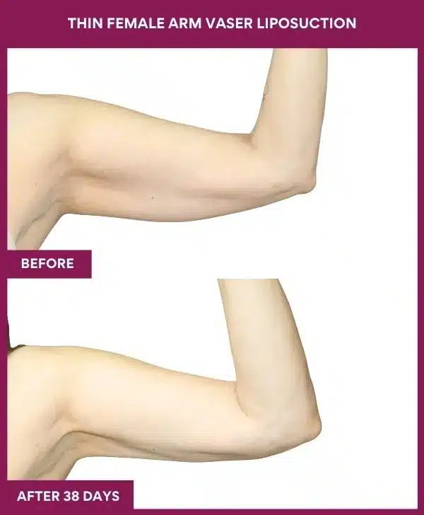 THIN FEMALE ARM VASER LIPOSUCTION in Mumbai, India