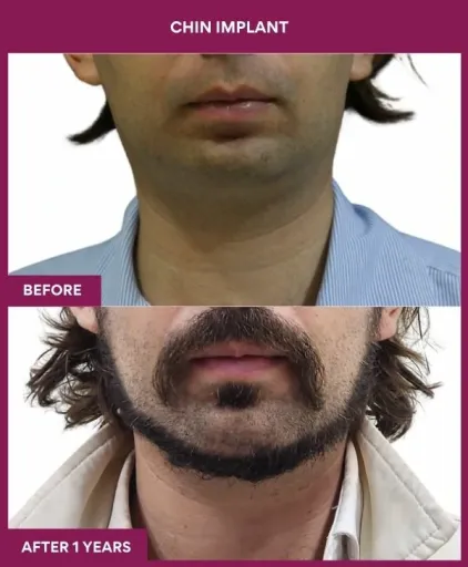 11 Chin Implant